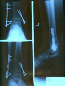 ankle_x-ray