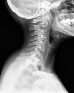 lead_poisoning