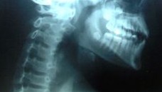 Spinal Cord Injury