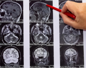 Chicago Traumatic Brain Injury Attorney