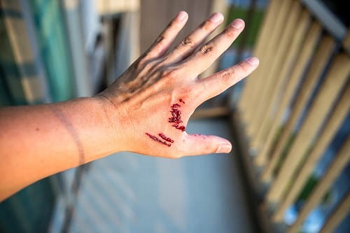 injured hand by a dog bite