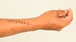 Phoenix Scarring Accident Injuries