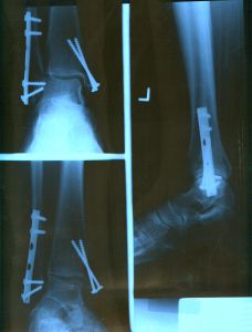 Broken bone and fracture lawyers