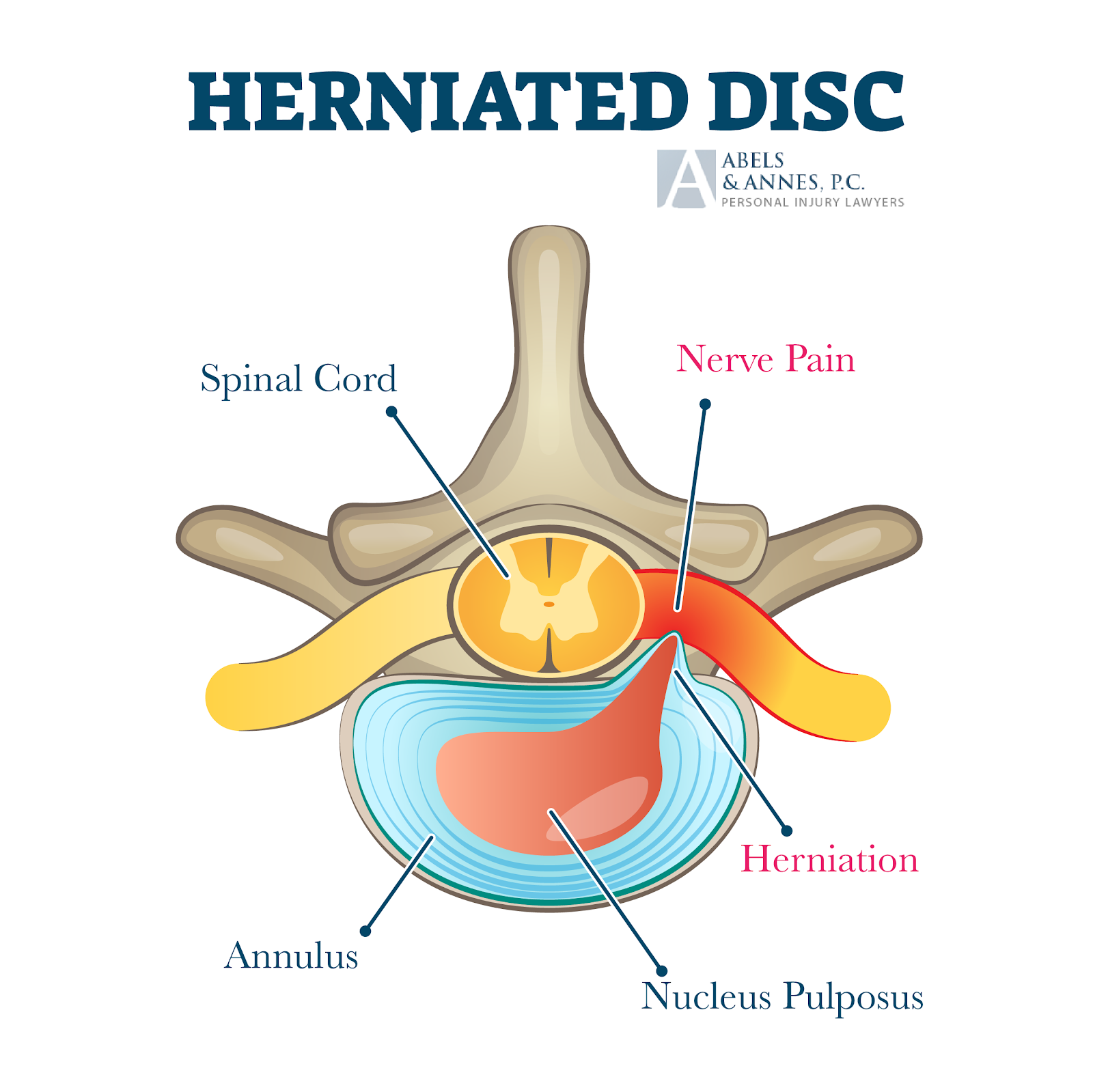 Herniated Disc - Abels and Annes Chicago Personal Injury Attorneys