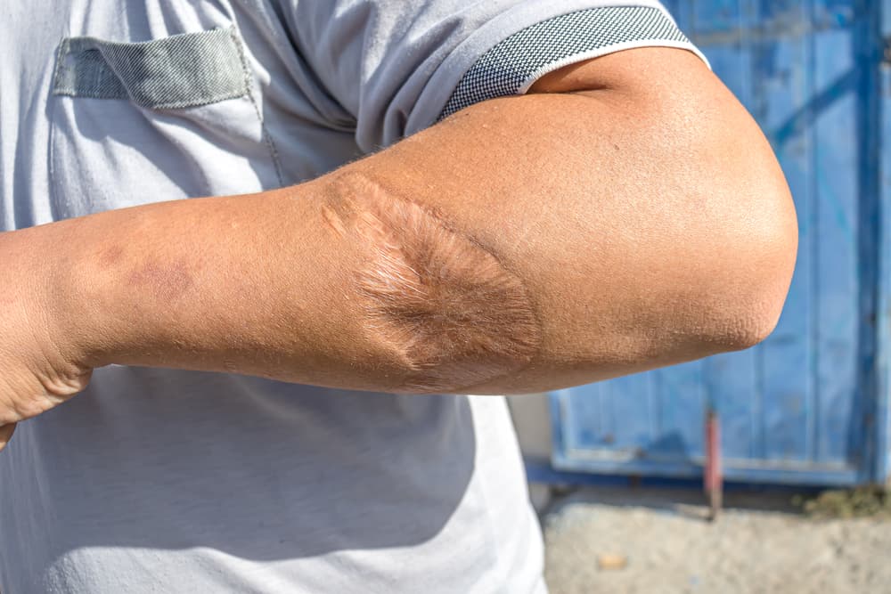 A visible scar on the arm resulting from a previous dog bite injury.